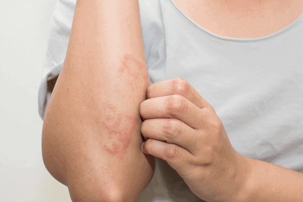 What is eczema? Symptoms and causes explained - ProVen Probiotics