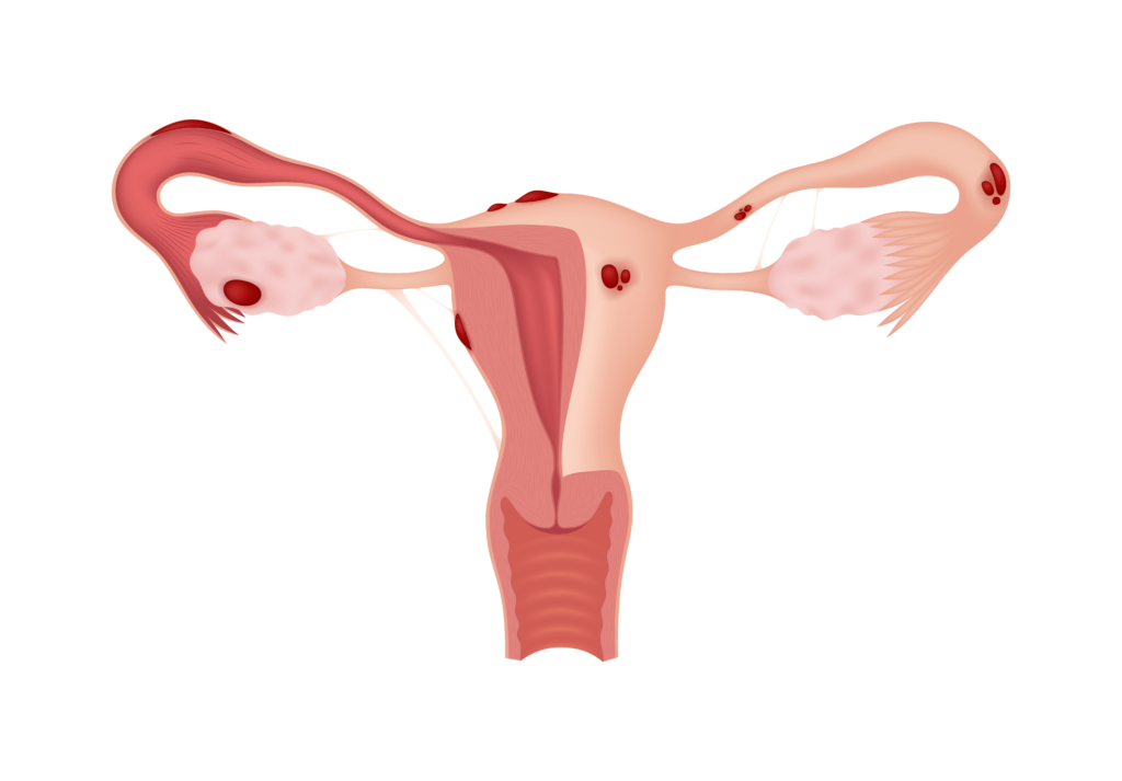 Illustration showing the reproductive system of a female and areas that can be affected by endometriosis